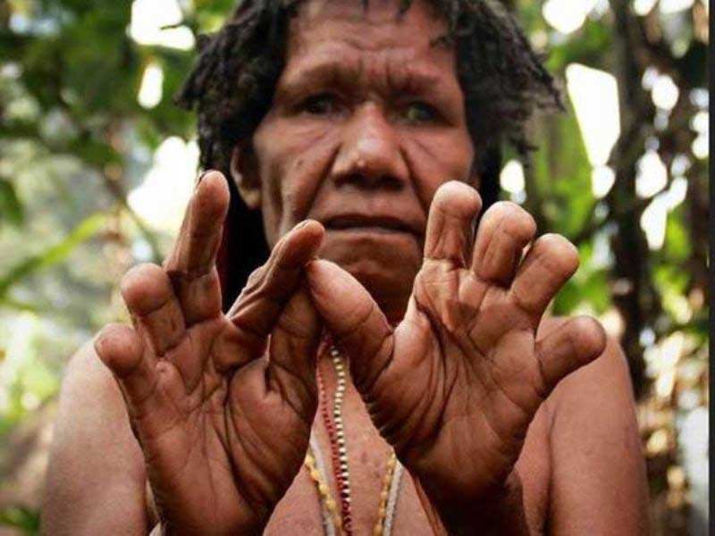 Finger Cutting Of Dani Tribe
